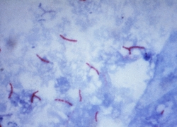 Normal_mycobacterium_tuberculosis_ziehl-neelsen_stain_02