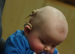 Normal_infant_with_cochlear_implant
