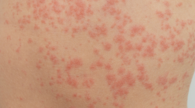 Carousel_urticaria-is-an-allergic-reaction-on-the-skin-red-2024-10-30-19-09-59-utc
