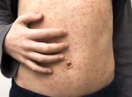 Normal_sick-child-body-stomach-with-red-rush-spots-from-2024-12-06-05-03-28-utc