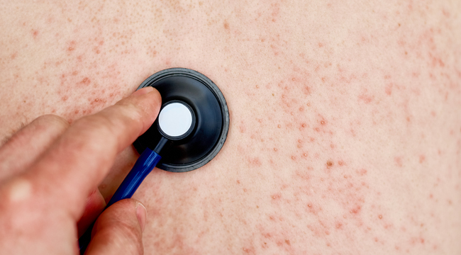 Carousel_allergic-rash-on-skin-woman-with-dermatology-prob-2025-03-15-01-04-31-utc